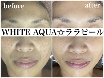 ホワイトアクア 鳳店(WHITE AQUA)/ララピール/大阪/鳳/毛穴/ツヤ肌