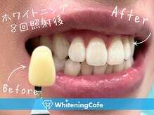 ホワイトニングカフェ 志木店/ホワイトニングビフォーアフター