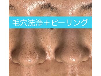 レアマカナ(LeaMakana)/毛穴洗浄+ピーリング