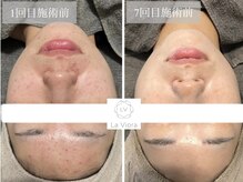 ラヴィオーラ 梅田店(La Viora)/ダイヤモンドハーブピーリング