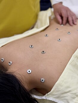 番町もくの木鍼灸院/灸　背部施術