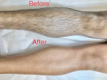 ロミオワックス 宇都宮店(ROMEO WAX)/脱毛ビフォーアフター(脚)