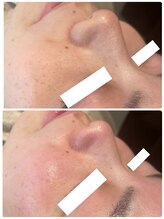 ディオーネ 春日井勝川店(Dione)/毛穴洗浄☆ビフォーアフター