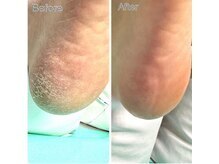 巻き爪補正店 札幌店/【かかとの角質ケア】