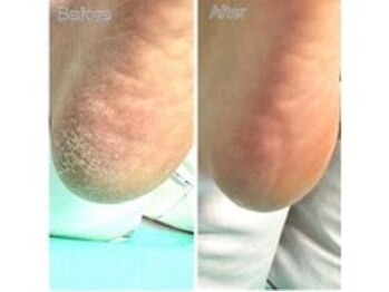 巻き爪補正店 札幌店/【かかとの角質ケア】