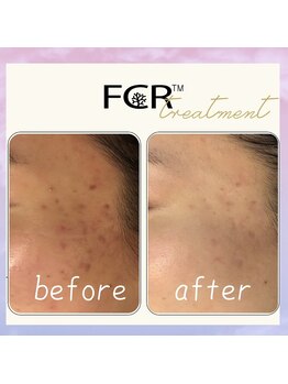 シャルム ココ 八尾店(Charme coco)/ニキビケア　1回目