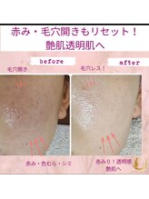 プライベートサロン 美月/毛穴色ムラ０艶肌1回の施術20代