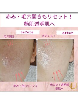 プライベートサロン 美月/毛穴色ムラ０艶肌1回の施術20代