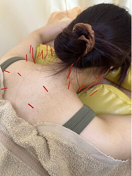 CA鍼灸整骨院の写真/【自律神経をととのえるはり施術で効果実感!】丁寧なカウンセリングで悩みに合わせて施術を選択いたします