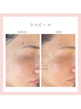 韓国肌管理yeoun【ヨウン】ROMAPINK/黒ずみ/毛穴/プラピール/ララピール福岡天神/ララピール/ララピール福岡