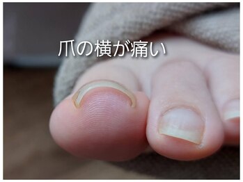 爪切り屋 足楽/巻いて食い込む爪も