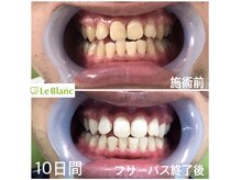 ルブラン 奈良店(Le Blanc)/定期的なホワイトニングで白く！