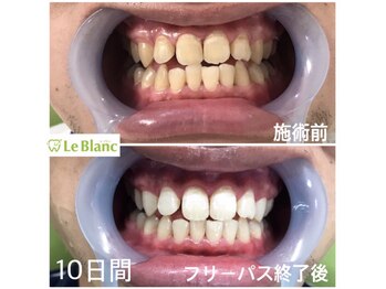ルブラン 奈良店(Le Blanc)/定期的なホワイトニングで白く!