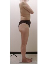 ジョイア 本店(Beauty＆Detox gioia)/塩尻市40代のお客様ビフォー