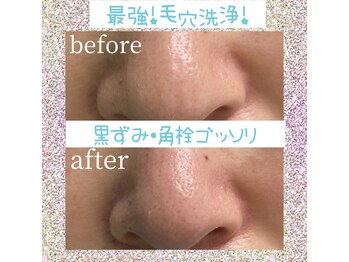 アンドワイ バイ サロンリーナ(&y by Salon Lena)/徹底的毛穴洗浄！