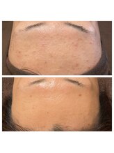 ビジュープラス 神栖店(Bijou+)/BeforeAfter(1年後)