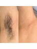 お試し！男性【両脇 　ワックス脱毛】