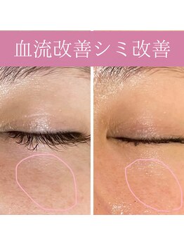 ミエル(miel)/【シミケア】くすみ改善・毛穴