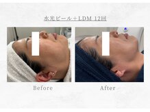 エヴァーグレース 三河安城店(EVER GRACE)/【肌管理】水光ピール＋LDM