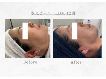 エヴァーグレース 三河安城店(EVER GRACE)/【肌管理】水光ピール＋LDM