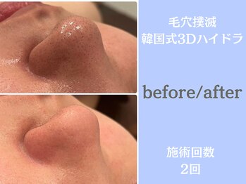 ウィア スキンサロン(Uvia skin salonk)/毛穴汚れ・毛穴開き/柏/松戸