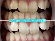 歯のホワイトニング 岐阜アクティブG店/Wホワイトニング施術写真☆