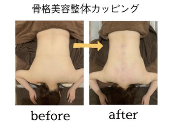 サクラプラス(SAKURA Plus)/骨格美容整体カッピング