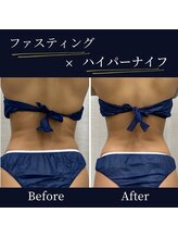 ハリルル 併設 GLケンタ鍼灸整骨院(HARILULU)/ハイパーナイフ