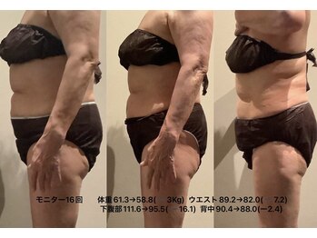 エステサロンルシア (LUCIA)/ラジオ波セル吸引撃退90分コース