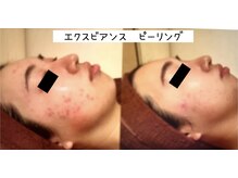 ビューティースパ/毛穴ニキビケアお悩みのある方へ