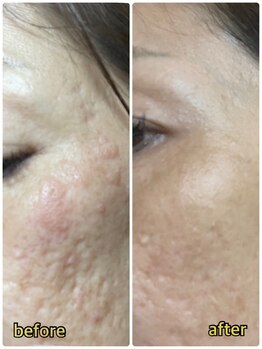 ジョルジオ東京/プラズマフラクショナル