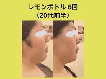 アユアラングレース/レモンボトル6回