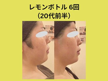 アユアラングレース/レモンボトル6回