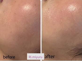 リミュール(Ri.miyuru)/ピーリングフェイシャル