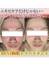 アルムダアクア 天王寺店(Aleumda AQUA)/ハーブピーリング/大阪/天王寺