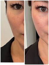 ミラヴィエ(Miravie)/新型RFリフト1回から1ヶ月の変化