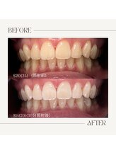 ホワイトニングビューティー 鯖江店(WHITENING BEAUTY)/初回30分照射コース