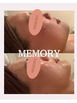 メモリー(MEMORY)/ニキビ、赤みが改善♪