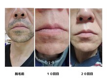 ヴィヴィオ たつの店(Vivio)/メンズ脱毛