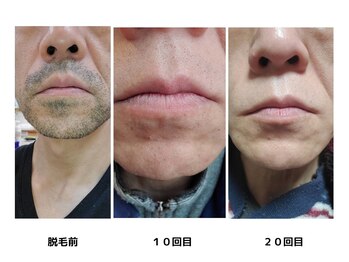 ヴィヴィオ たつの店(Vivio)/メンズ脱毛