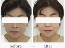 エレランサ/ビフォーアフター(40代)