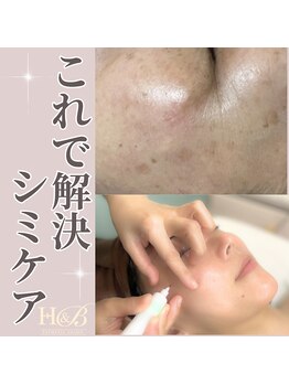 エステティック エイチアンドビー 大和店(H&B)/シミケア　フェイシャル