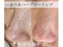 エクレ(eclat)/毛穴悩み根本改善！