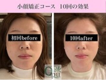キュープ 福岡九大学研都市店(Qpu)/小顔矯正１０回コースの変化