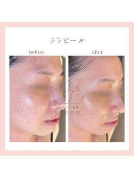 韓国肌管理yeoun【ヨウン】ROMAPINK/黒ずみ/毛穴/プラピール/ララピール福岡天神/ララピール/ララピール福岡