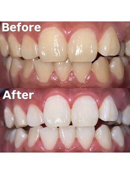 ホワイトニングビューティー 光の森店(WHITENING BEAUTY)/ホワイトニング♪