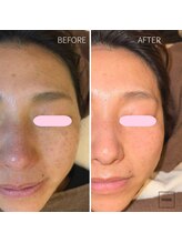 ギルドハナレ(GUILD HANARE)/"プラズマシャワー × シミケア"