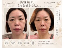 ハリプラス(HariPlus)の雰囲気（【美容鍼でフェイシャルケア】たるみ・むくみ・もたつきを解消！）