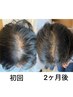 頭皮ケアの高濃度プラセンタエッセンス使用ヘッドスパ 75分¥7,000