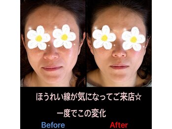 美容矯正サロン レレポノ(LELEPONO)/ほうれい線撃退
